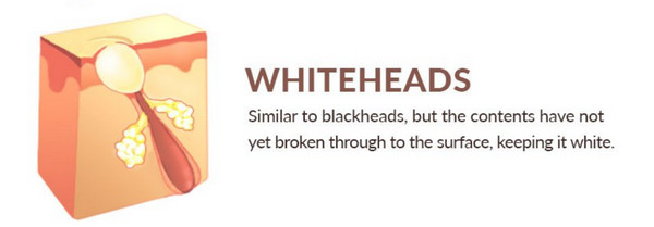 Whiteheads develop when dead skin cells, sebum (oil), and dirt clog your pores. Unlike blackheads, which can be pushed out, whiteheads are closed within the pore