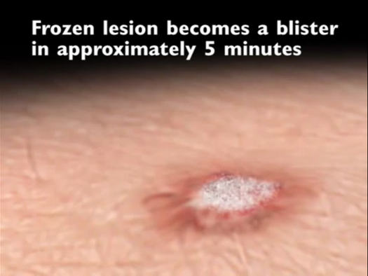 cryo lesion to blister