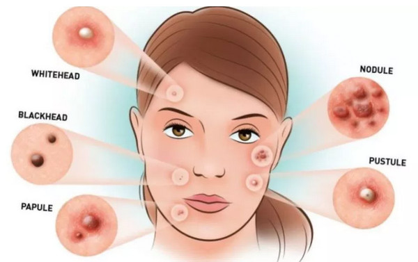 Acne Vulgaris presents different types of acne lesions blackheads, whiteheads, papules, pustules, nodules, and cysts