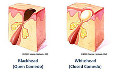 Blackheads and whiteheads are a specific type of acne called comedones