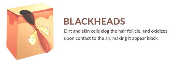 Blackheads are caused by your skin producing too much oil which turns dark when exposed to air