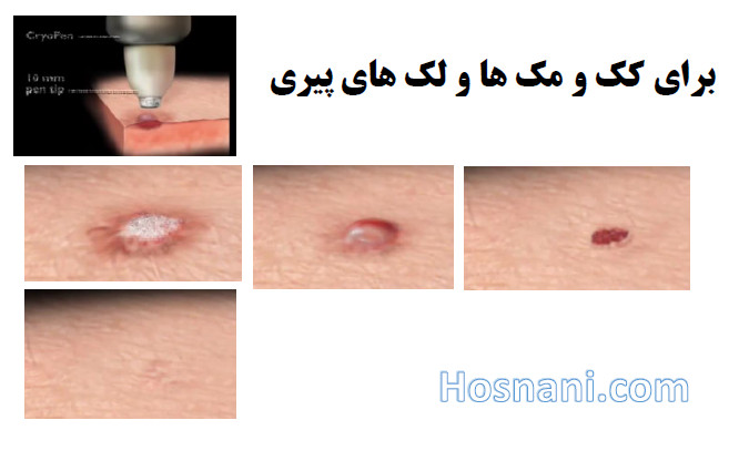 CryoPen is a Cryotherapy for removal of skin imperfections such as skin tags, milia and age spots