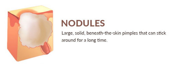 Nodular acne is a severe form of acne that causes large, inflamed, and painful breakouts called acne nodules