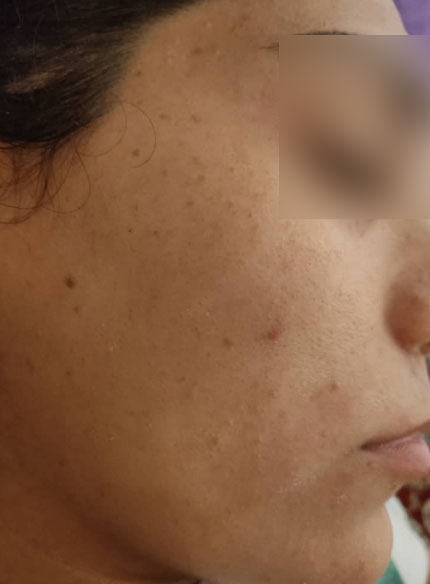 PIH+melasma