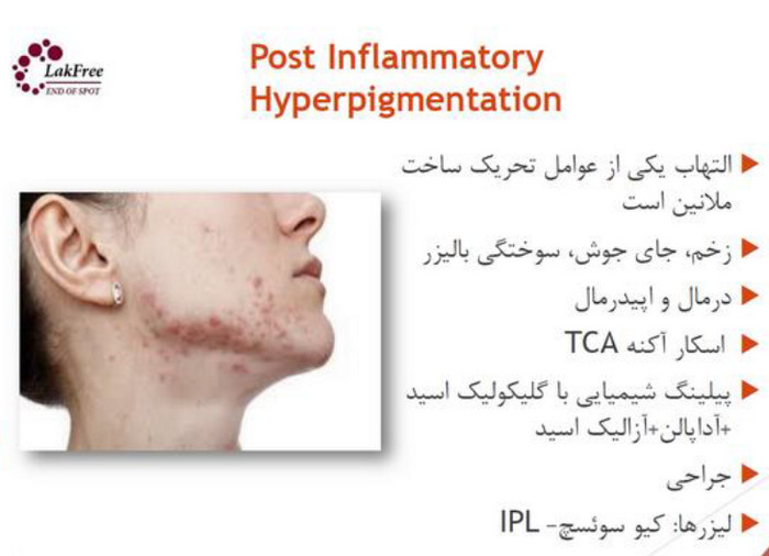 Postinflammatory pigmentation is temporary pigmentation that follows injury