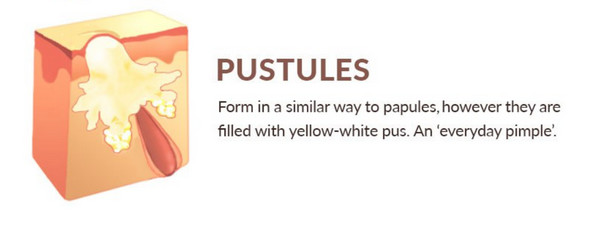 Pustules are small bumps on the skin that contain fluid or pus