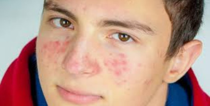 acne boy