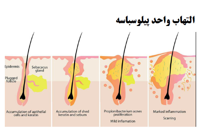 acne is chronic inflammatory disease of the pilocebaceous unit