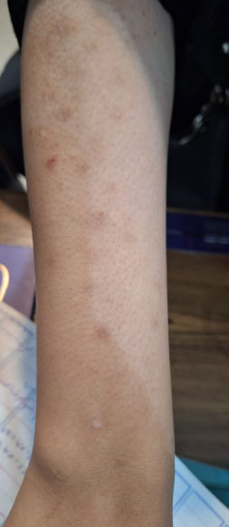 acne mechanical