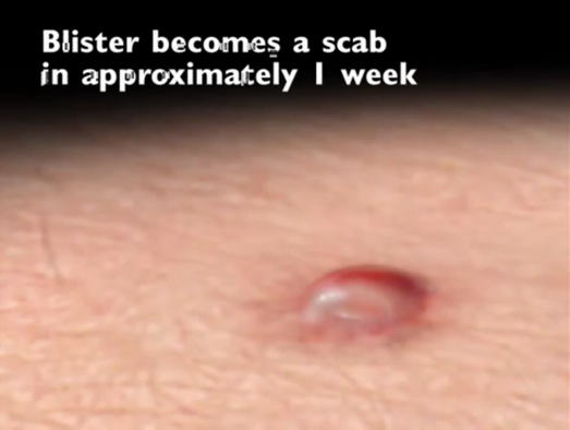 cryo blister to scab