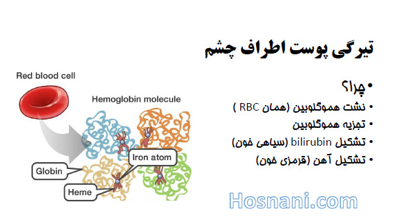 علت های تیرگی پوست اطراف چشم