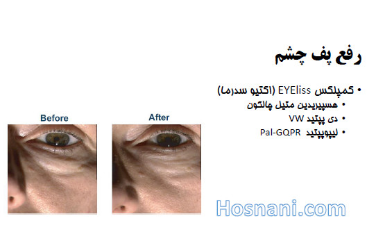 هسپیریدین متیل چالکون برای رفع پف دور چشم