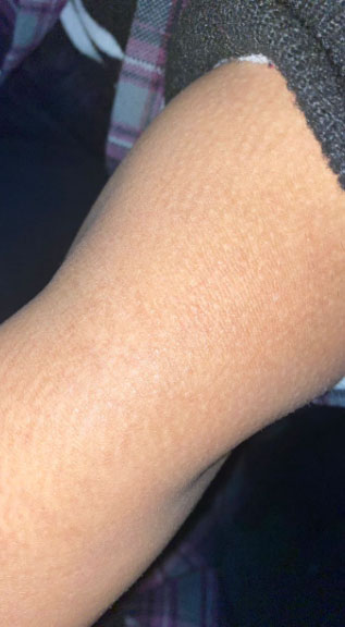 post inflammatory hypopigmentation