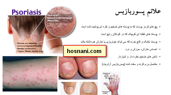 عکس بیماری پسوریازیس + علائم + درمان